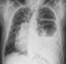 Left basal atelectasis, air-fluid levels, ipsilateral  hemidiaphragm elevation with irregular edges and mediastinal shift  to the contralateral side.