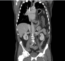 Voluminous left diaphragmatic hernia with secondary  herniation of stomach, splenic flexure and most of the transverse  colon