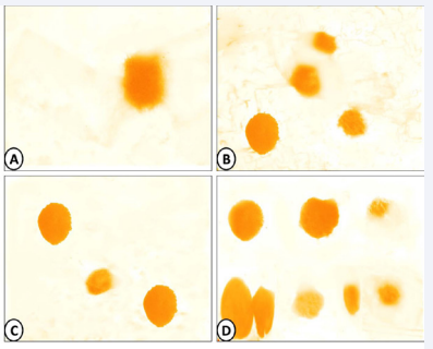 Photomicrographs of 1% Sudan III stained fecal smears showing fat droplets distribution in group C (daily orally 0.1 ml administered distilled water) (A), Group (MA) (25 mg melamine /kg bw/day) (B), Group (FA) (50 mg formaldehyde /kg bw/day) (C) and Group (MA+ FA) (D). (x 200).